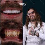 Resultados antes y después de coronas de zirconia en Mira Clinic, sonrisa natural