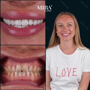 Résultats avant et après pose de couronnes dentaires à Mira Clinic, sourire amélioré