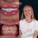 Résultats avant et après pose de couronnes dentaires à Mira Clinic, sourire amélioré