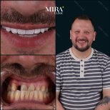 Résultats avant et après pose de couronnes dentaires à Mira Clinic, sourire amélioré