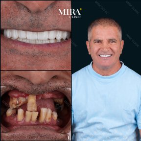 Résultats avant et après pose de couronnes dentaires à Mira Clinic, sourire amélioré