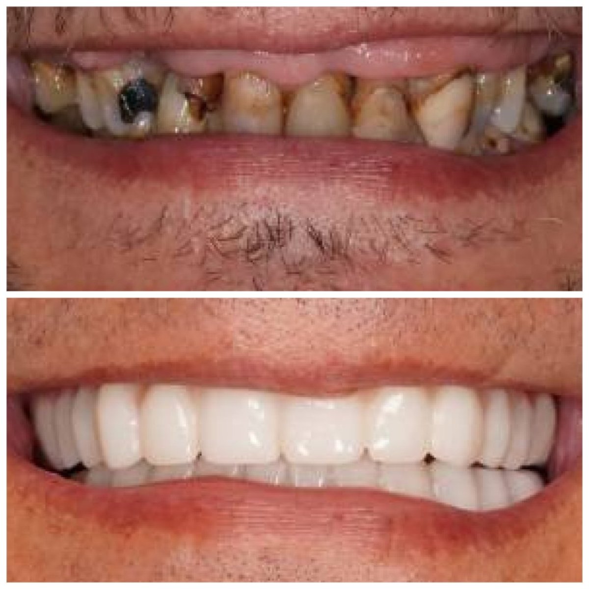 نتائج ترميم الأسنان (الترابط) قبل وبعد في Baron Dental Clinic، ابتسامة محسنة