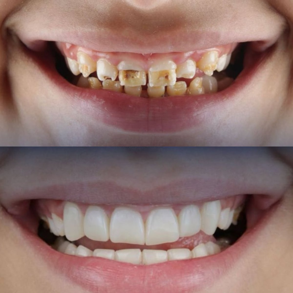 Antes y después de carillas Emax en Sunrise Dental Clinic: transformación natural de la sonrisa