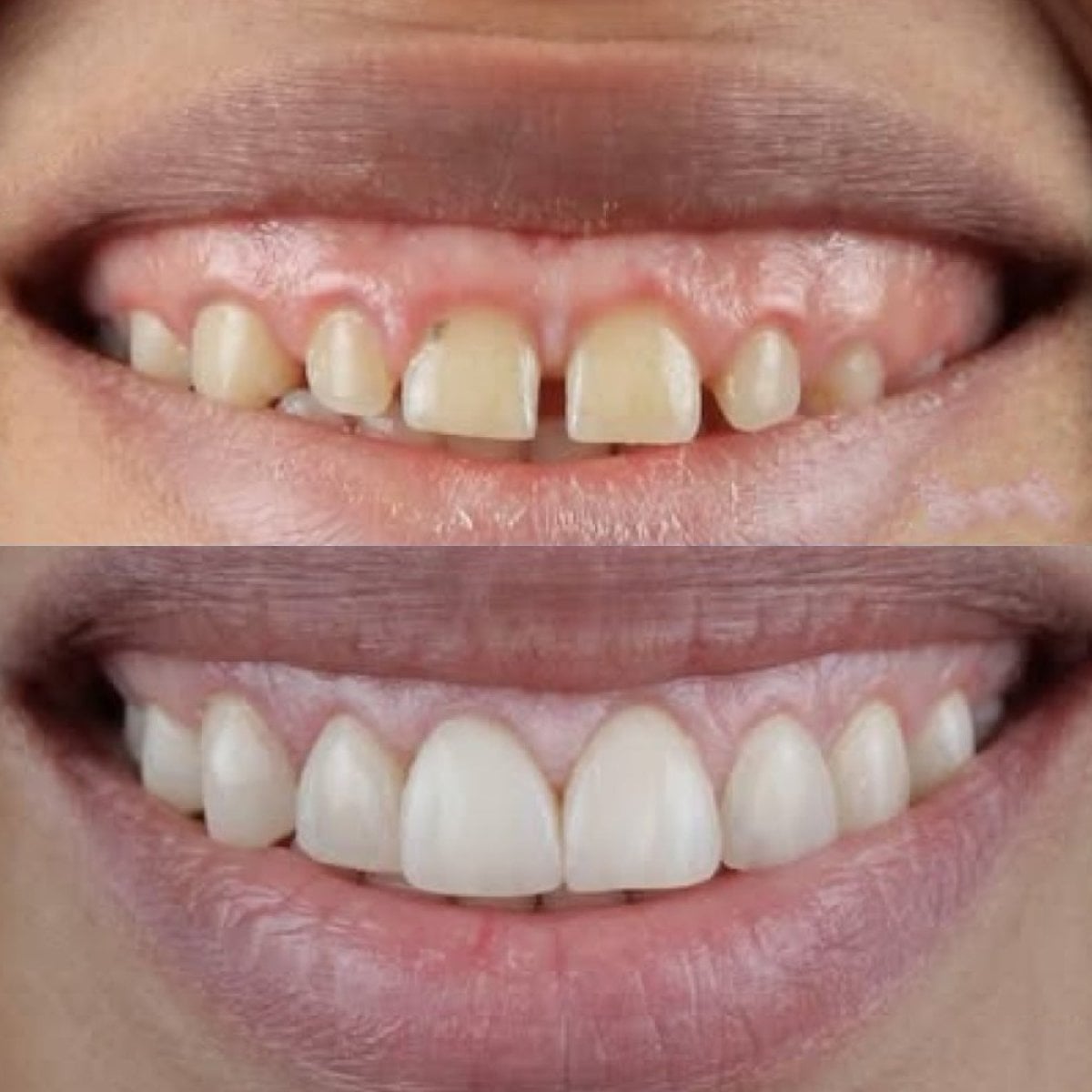 Resultado antes y después de carillas en Sunrise Dental Clinic: sonrisa mejorada y dientes blancos