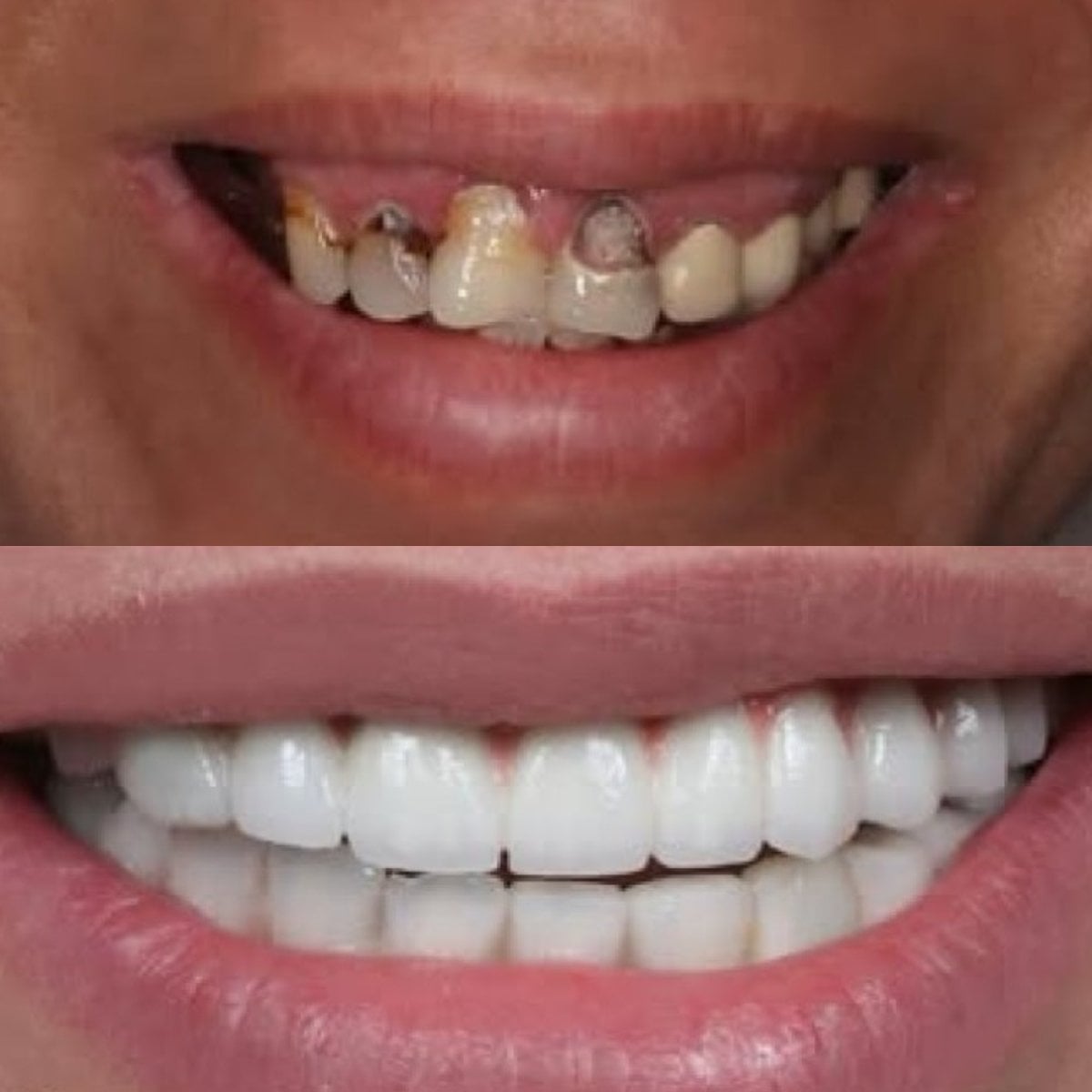 نتيجة قبل وبعد زراعة الأسنان All-on-4 في Sunrise Dental Clinic، استعادة الابتسامة