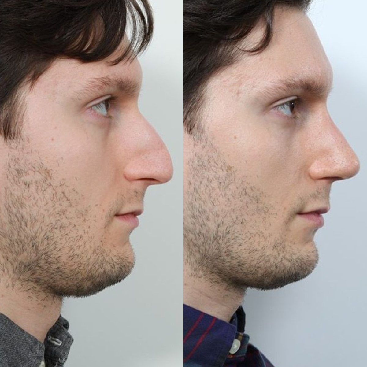 Resultado antes y después de rinoplastia líquida en Op. Dr. Evren Ay Koç, remodelación nasal sin cirugía