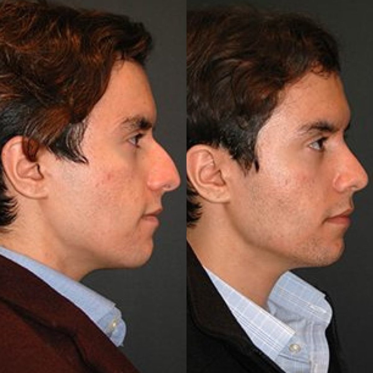 نتيجة قبل وبعد تجميل الأنف السائل في Op. Dr. Evren Ay Koç، تعديل الأنف بدون جراحة