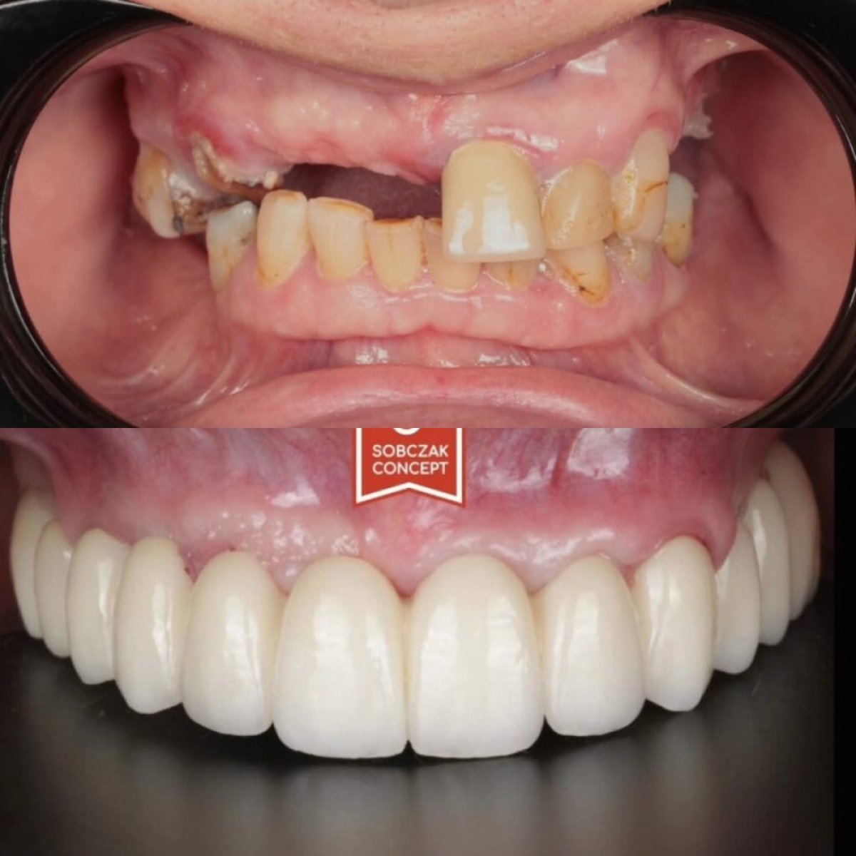 Resultados antes y después de coronas dentales en DR SOBCZAK KLINIKI, restauración de sonrisa