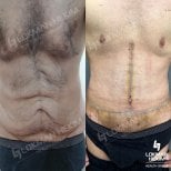 Résultats avant/après sculpture abdominale à Lokman Hekim Istanbul Hospital, abdos