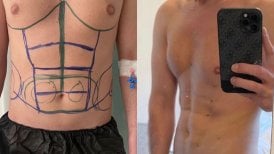Résultats avant/après sculpture abdominale à Lokman Hekim Istanbul Hospital, abdos dessinés