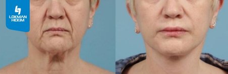 Résultats avant et après lifting deep plane au Lokman Hekim Istanbul Hospital, rajeunissement du visage