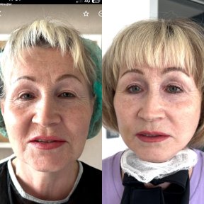 Résultats avant et après lifting deep plane à Lokman Hekim Istanbul Hospital, rajeunissement du visage