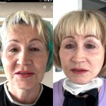 Résultats avant et après lifting deep plane à Lokman Hekim Istanbul Hospital, rajeunissement du visage