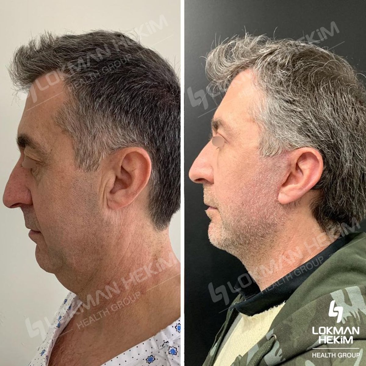 Resultados antes y después de lifting facial profundo en Lokman Hekim Istanbul Hospital, rejuvenecimiento facial