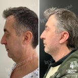 Résultats avant et après lifting deep plane au Lokman Hekim Istanbul Hospital, rajeunissement du visage