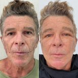 Résultats avant et après deep plane facelift à Lokman Hekim Istanbul Hospital, rajeunissement du visage