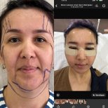 Résultats avant et après lifting Deep Plane à Lokman Hekim Istanbul Hospital, rajeunissement du visage