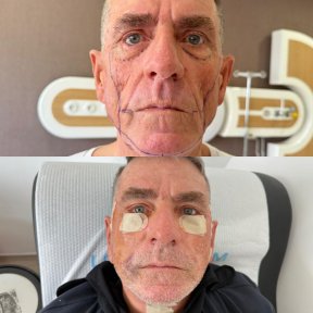 Résultats avant et après lifting deep plane au Lokman Hekim Istanbul Hospital, rajeunissement du visage