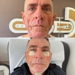 Résultats avant et après lifting deep plane au Lokman Hekim Istanbul Hospital, rajeunissement du visage