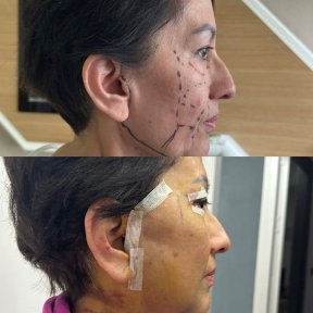 Résultats avant et après lifting deep plane à Lokman Hekim Istanbul Hospital, rajeunissement du visage