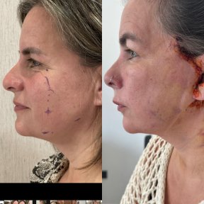 Résultats avant et après lifting deep plane au Lokman Hekim Istanbul Hospital, rajeunissement du visage