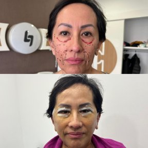 Résultats avant et après lifting deep plane au Lokman Hekim Istanbul Hospital, rajeunissement du visage