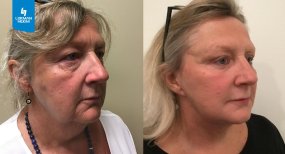 Résultats avant et après lifting deep plane au Lokman Hekim Istanbul Hospital, rajeunissement du visage