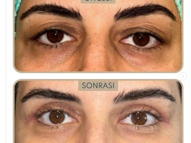 Blepharoplastik Vorher-Nachher-Ergebnis bei Dunyagoz Eye Hospital Istanbul Etiler