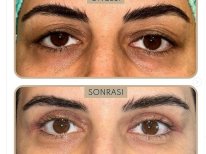 Blepharoplastik Vorher-Nachher-Ergebnis bei Dunyagoz Eye Hospital Istanbul Etiler