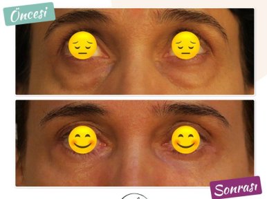 Blepharoplastik Vorher-Nachher-Ergebnis bei Dunyagoz Eye Hospital Istanbul Etiler