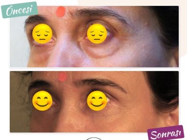 Blepharoplastik Vorher-Nachher-Ergebnis bei Dunyagoz Eye Hospital Istanbul Etiler