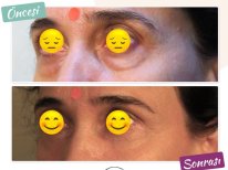 Blepharoplastik Vorher-Nachher-Ergebnis bei Dunyagoz Eye Hospital Istanbul Etiler