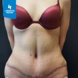 Résultat d'abdominoplastie à Lokman Hekim Istanbul Hospital – cicatrice visible, ventre raffermi