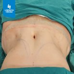 Résultat d'abdominoplastie à Lokman Hekim Istanbul Hospital avec ventre plat après chirurgie