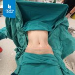Résultat d'abdominoplastie à Lokman Hekim Istanbul Hospital, ventre plat après chirurgie