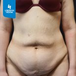 Avant abdominoplastie à Lokman Hekim Istanbul Hospital, excès de peau abdominale