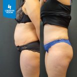 Résultats avant/après abdominoplastie à Lokman Hekim Istanbul Hospital, ventre plat