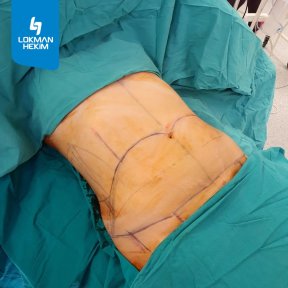 Préparation à l'abdominoplastie à Lokman Hekim Istanbul Hospital, remodelage abdominal