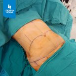 Préparation à l'abdominoplastie à Lokman Hekim Istanbul Hospital, remodelage abdominal