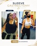 Before and after gastric sleeve surgery at Estexper Clinic – 44kg weight loss in 10 months