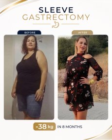 Before and after gastric sleeve surgery at Estexper Clinic – 38 kg weight loss in 8 months result