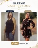 Before and after gastric sleeve surgery at Estexper Clinic – 38 kg weight loss in 8 months result