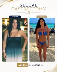 Before and after gastric sleeve surgery at Estexper Clinic – 40 kg weight loss result in 10 months