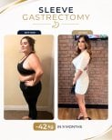 Before and after gastric sleeve surgery at Estexper Clinic – 42 kg weight loss in 9 months