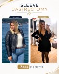 Before and after gastric sleeve surgery at Estexper Clinic – 34 kg weight loss in 6 months