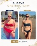 Before and after gastric sleeve surgery at Estexper Clinic – 38 kg weight loss in 9 months