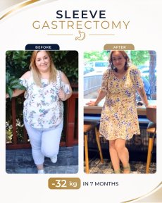 Before and after gastric sleeve surgery at Estexper Clinic – 32 kg weight loss in 7 months