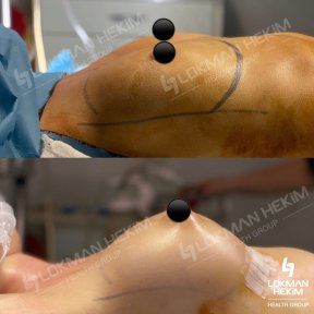 Avant et après augmentation mammaire par implants en silicone à Lokman Hekim Istanbul