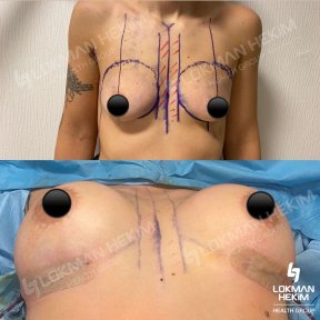 Avant et après augmentation mammaire par implants en silicone à Lokman Hekim Istanbul