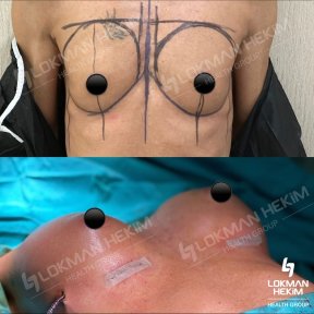 Avant et après augmentation mammaire par implants en silicone à Lokman Hekim Istanbul